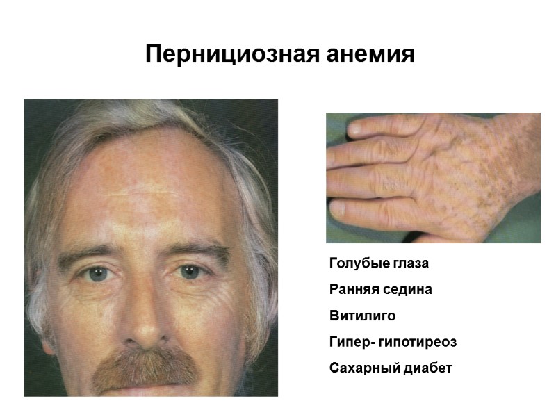 Пернициозная анемия Голубые глаза Ранняя седина Витилиго Гипер- гипотиреоз Сахарный диабет